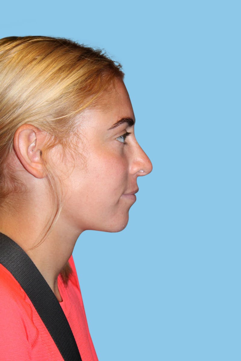 Rhinoplasty Before & After Gallery - Patient 337257 - Image 4