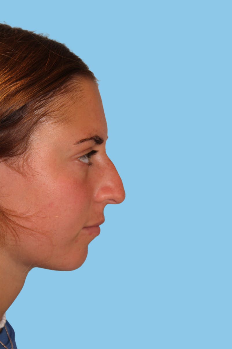 Rhinoplasty Before & After Gallery - Patient 337257 - Image 3