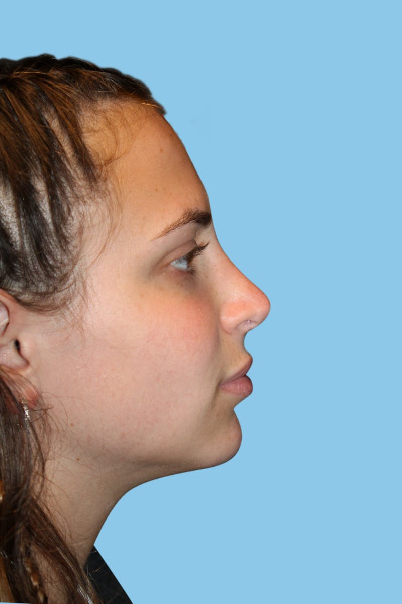 Rhinoplasty Before & After Gallery - Patient 196440 - Image 4