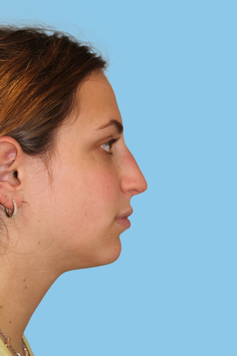 Rhinoplasty Before & After Gallery - Patient 196440 - Image 3