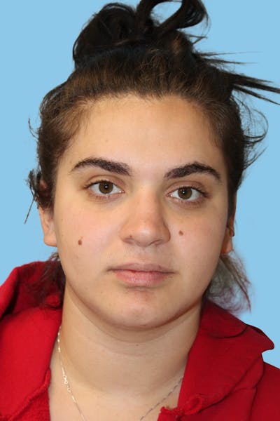 Rhinoplasty Before & After Gallery - Patient 315154 - Image 2