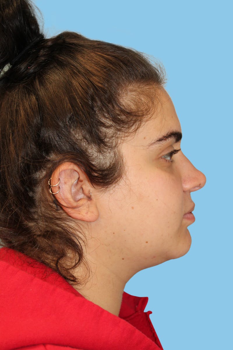 Rhinoplasty Before & After Gallery - Patient 315154 - Image 4