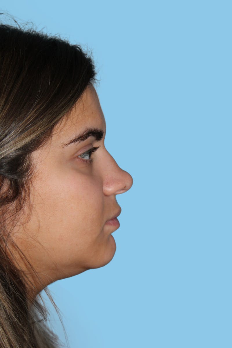 Rhinoplasty Before & After Gallery - Patient 315154 - Image 3