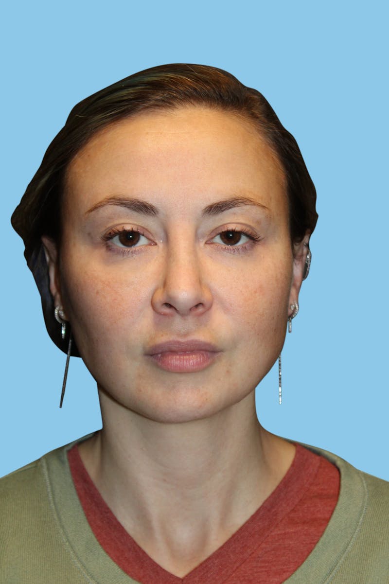 Rhinoplasty Before & After Gallery - Patient 614066 - Image 2