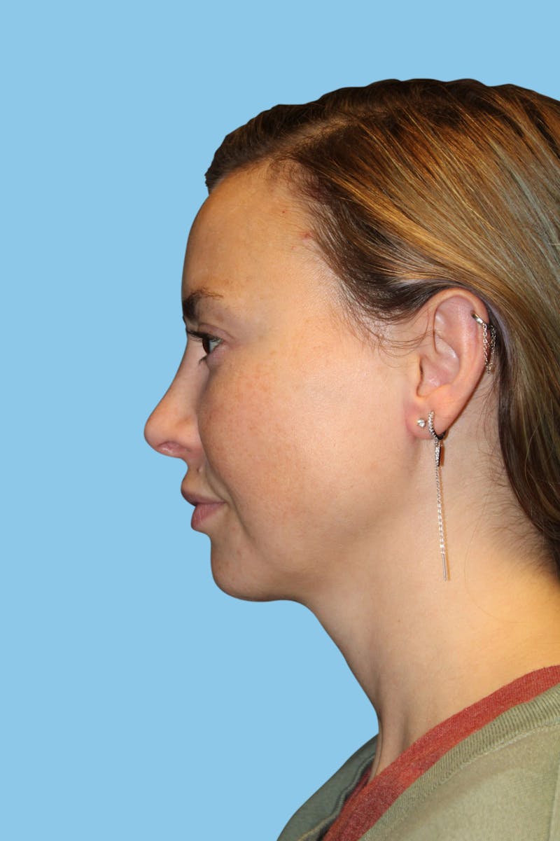 Rhinoplasty Before & After Gallery - Patient 614066 - Image 4