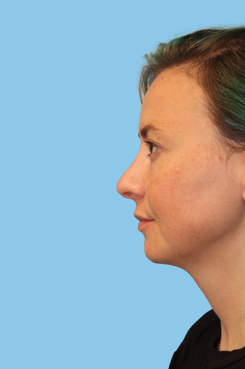 Rhinoplasty Before & After Gallery - Patient 614066 - Image 3