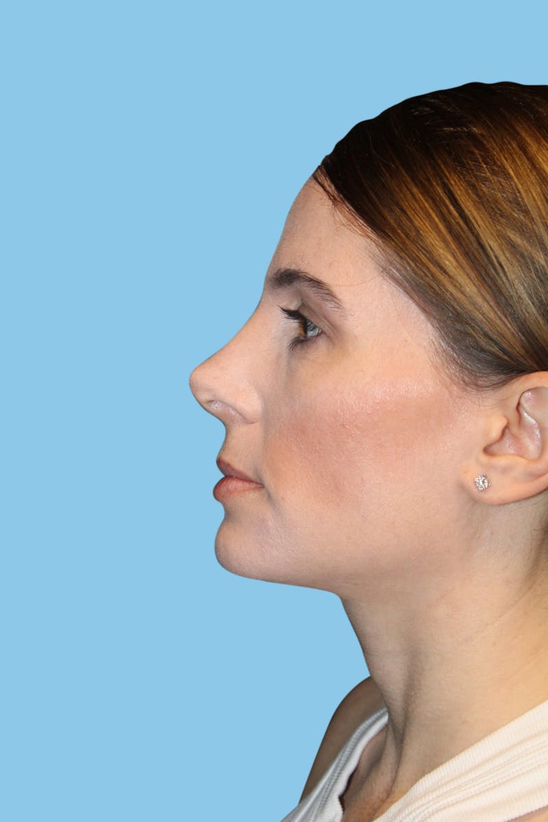 Rhinoplasty Before & After Gallery - Patient 875769 - Image 4