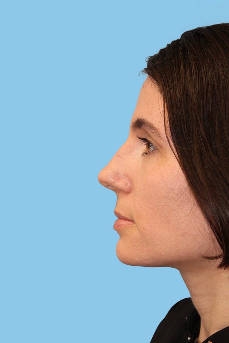 Rhinoplasty Before & After Gallery - Patient 875769 - Image 3