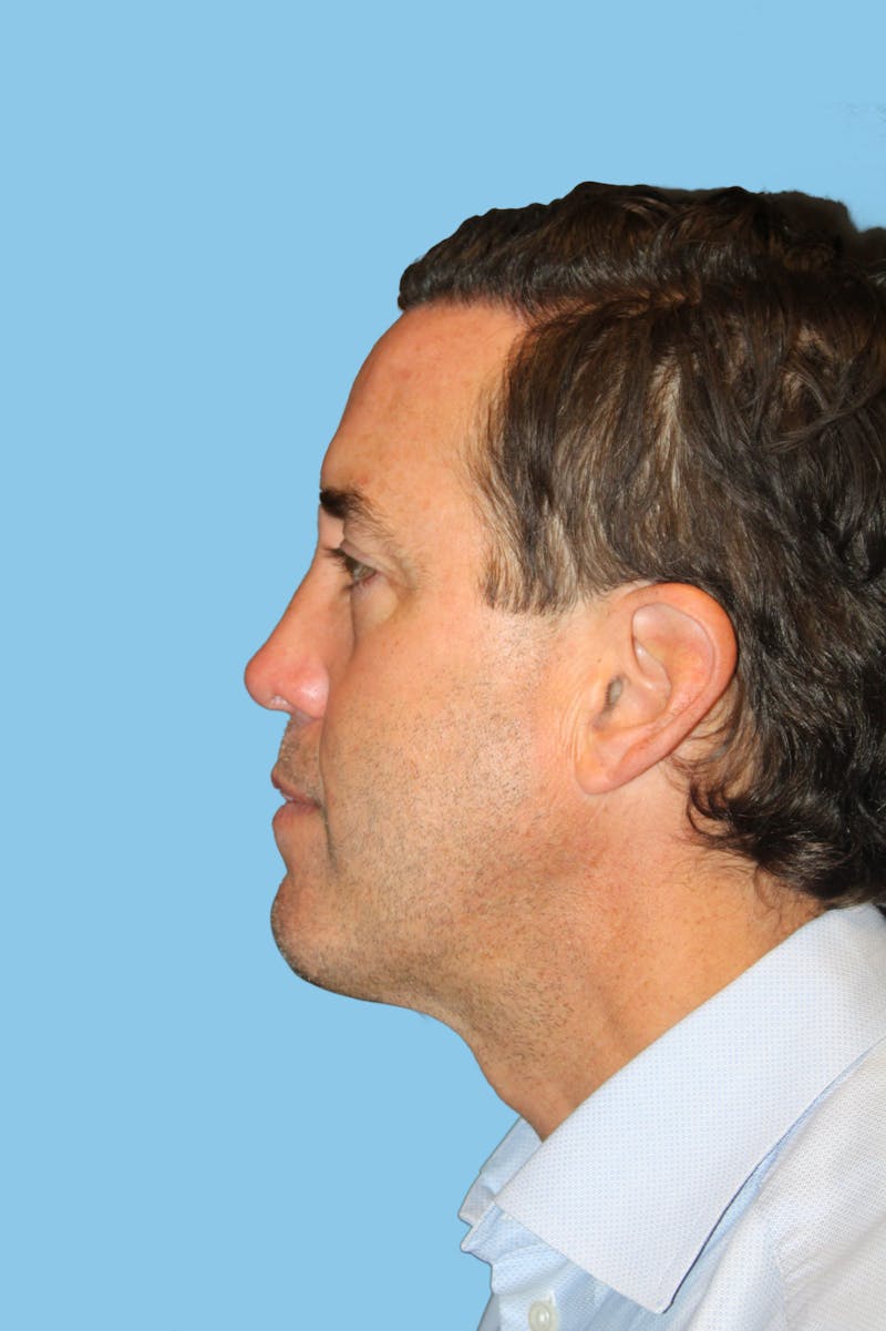 Rhinoplasty Before & After Gallery - Patient 366691 - Image 4