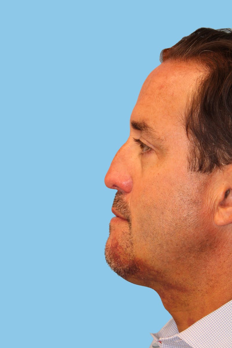 Rhinoplasty Before & After Gallery - Patient 366691 - Image 3