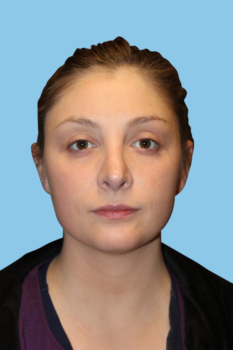 Rhinoplasty Before & After Gallery - Patient 130288 - Image 2