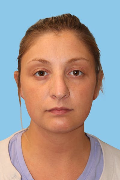 Rhinoplasty Before & After Gallery - Patient 130288 - Image 1