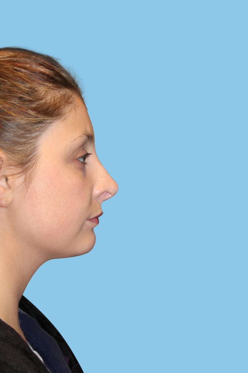 Rhinoplasty Before & After Gallery - Patient 130288 - Image 4