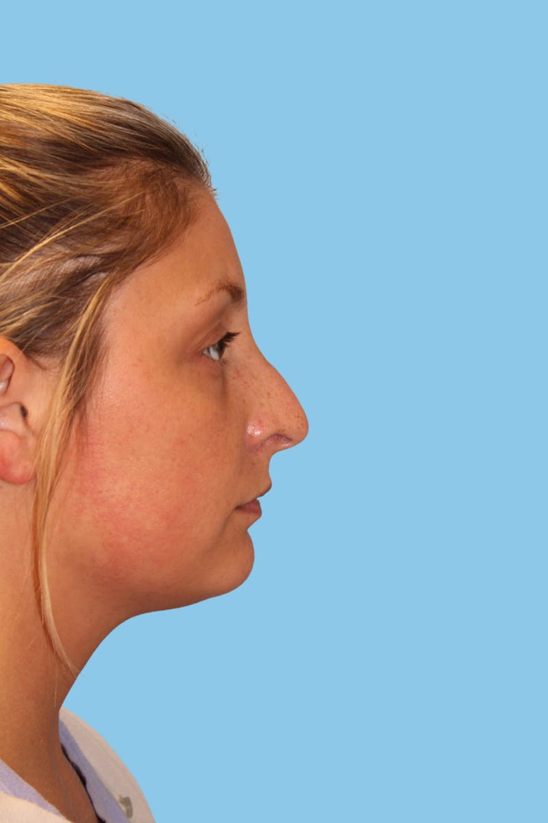 Rhinoplasty Before & After Gallery - Patient 130288 - Image 3