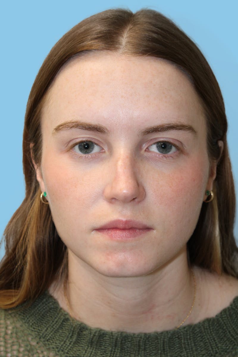 Rhinoplasty Before & After Gallery - Patient 244547 - Image 1
