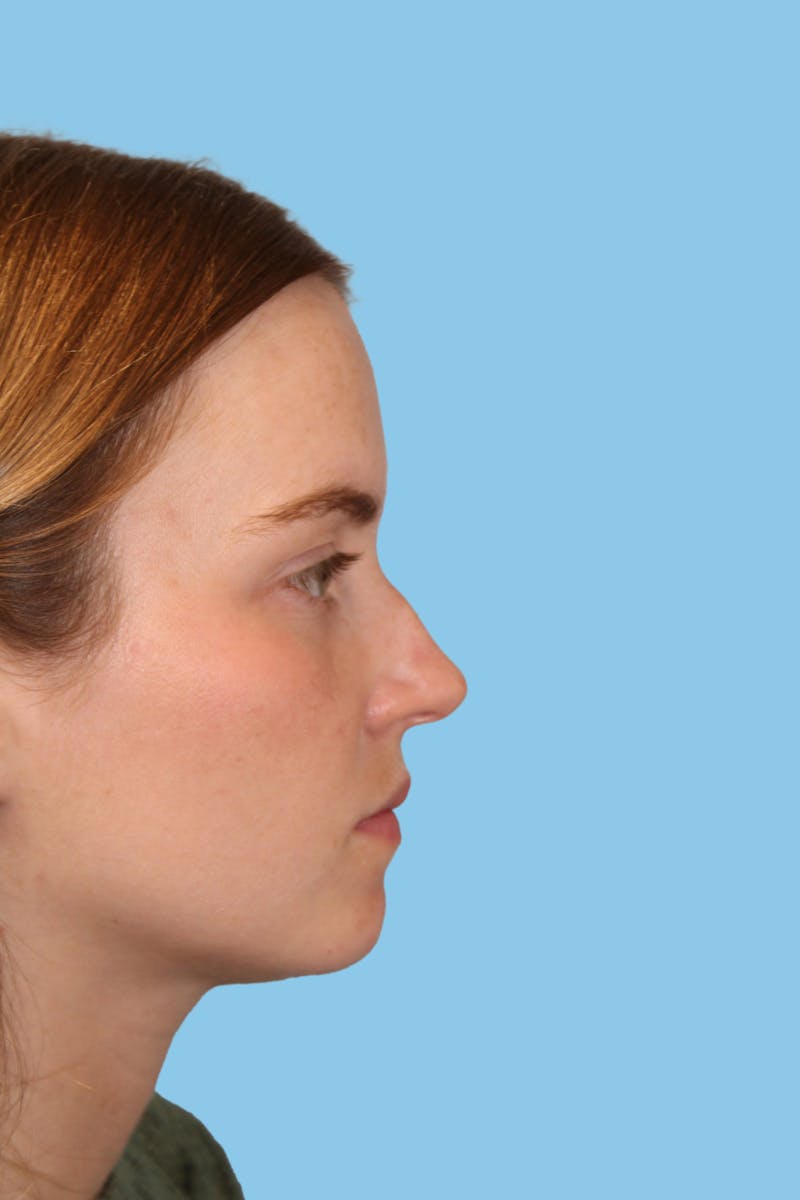 Rhinoplasty Before & After Gallery - Patient 244547 - Image 3