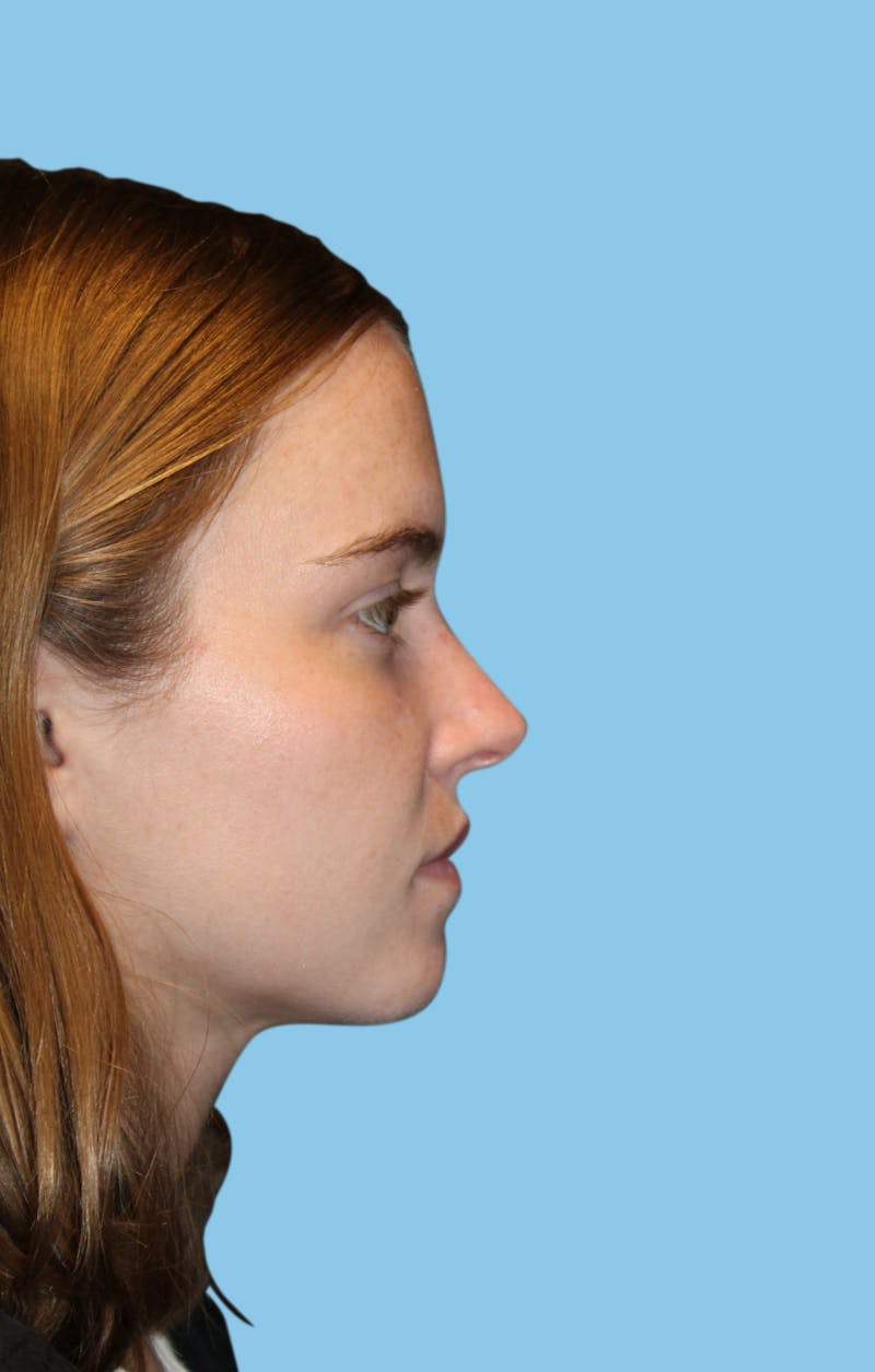 Rhinoplasty Before & After Gallery - Patient 244547 - Image 4