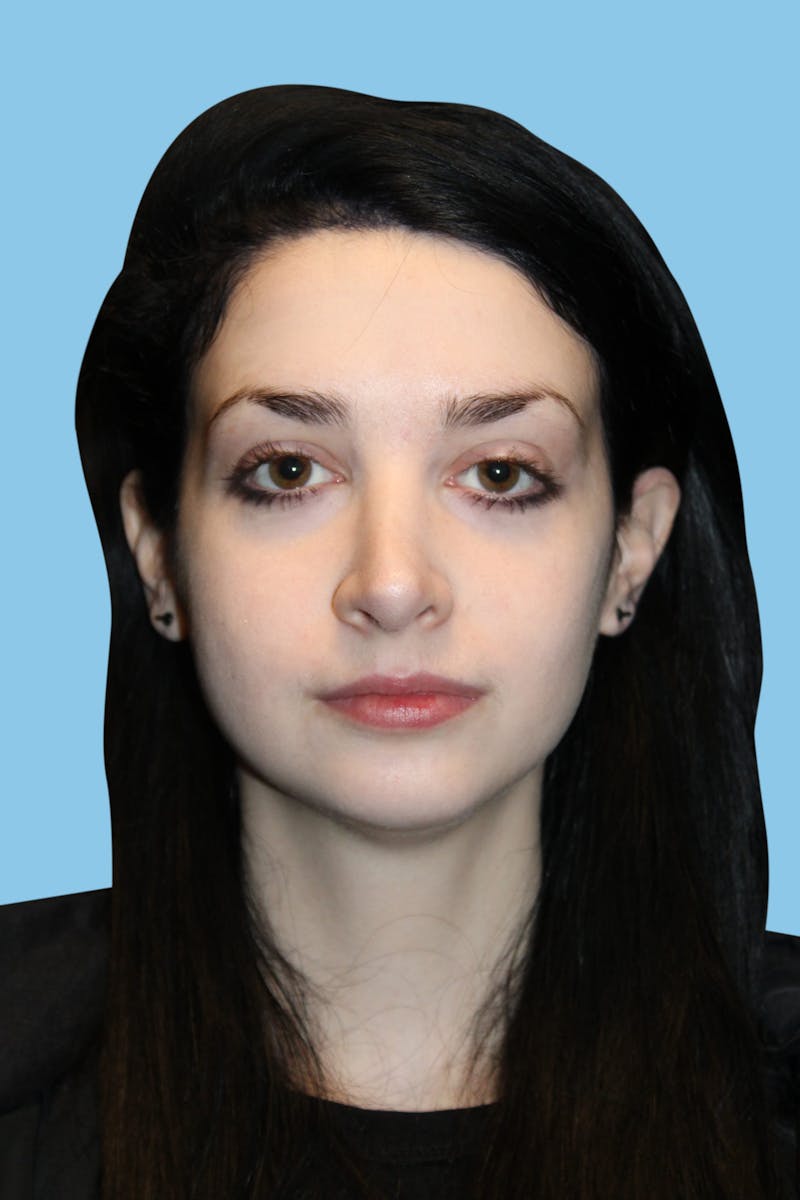 Rhinoplasty Before & After Gallery - Patient 706872 - Image 1