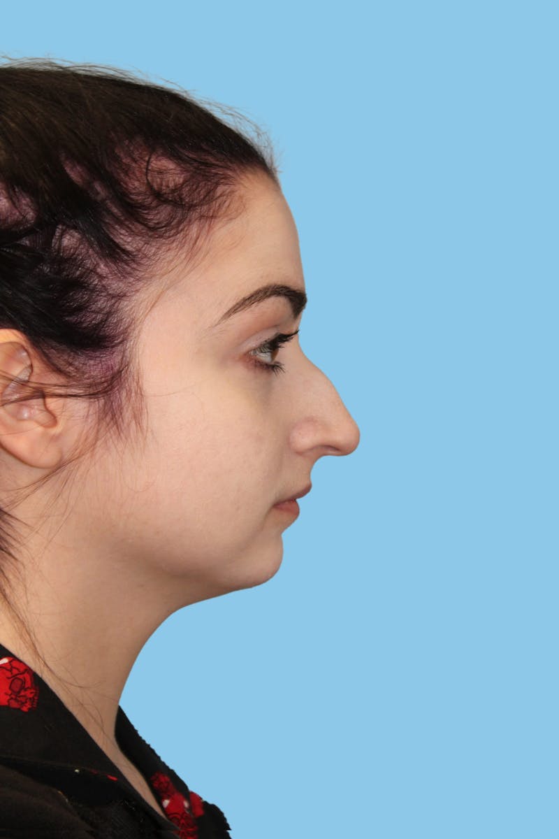 Rhinoplasty Before & After Gallery - Patient 706872 - Image 3