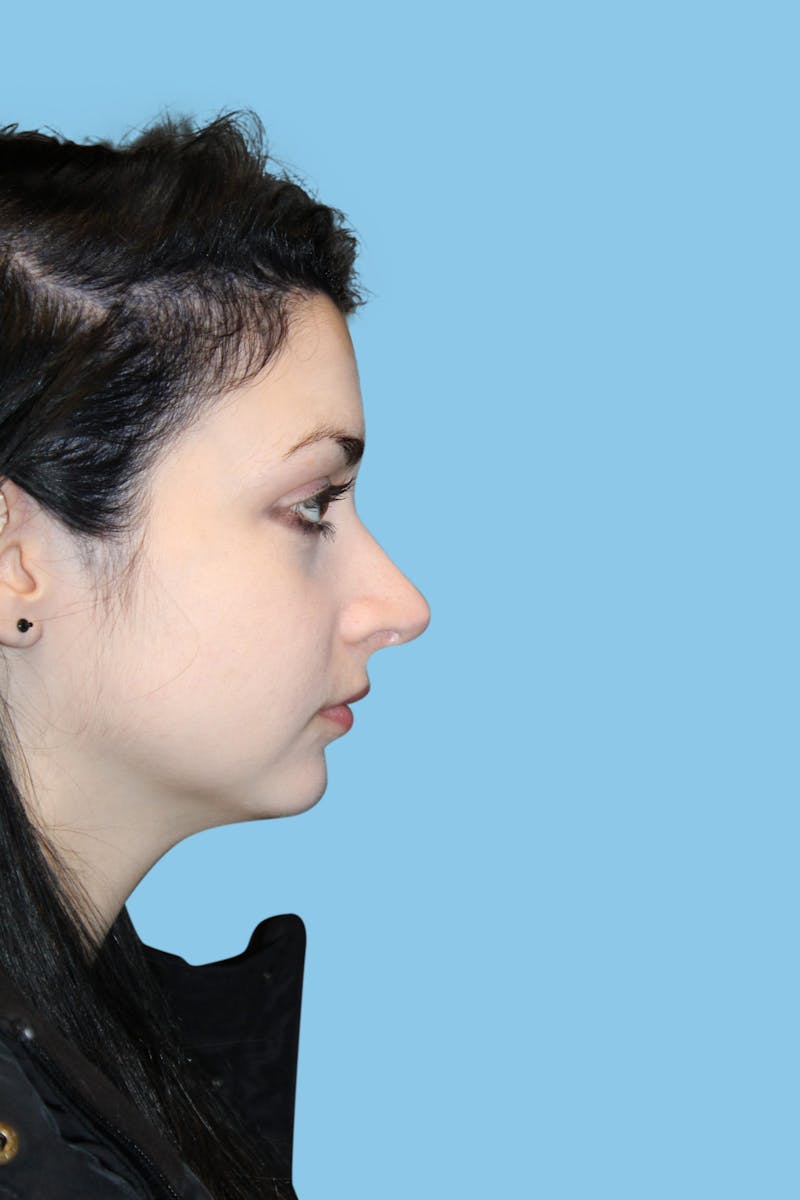 Rhinoplasty Before & After Gallery - Patient 706872 - Image 4