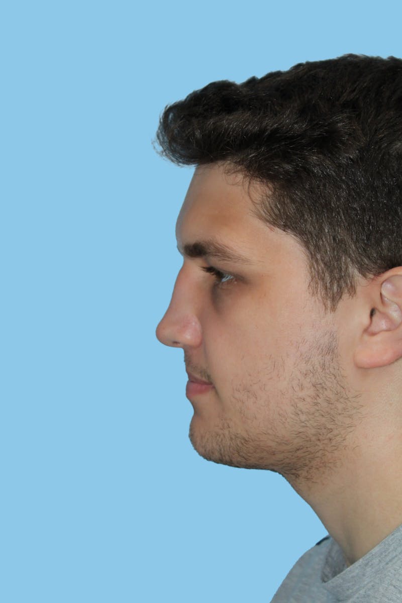 Rhinoplasty Before & After Gallery - Patient 396221 - Image 3