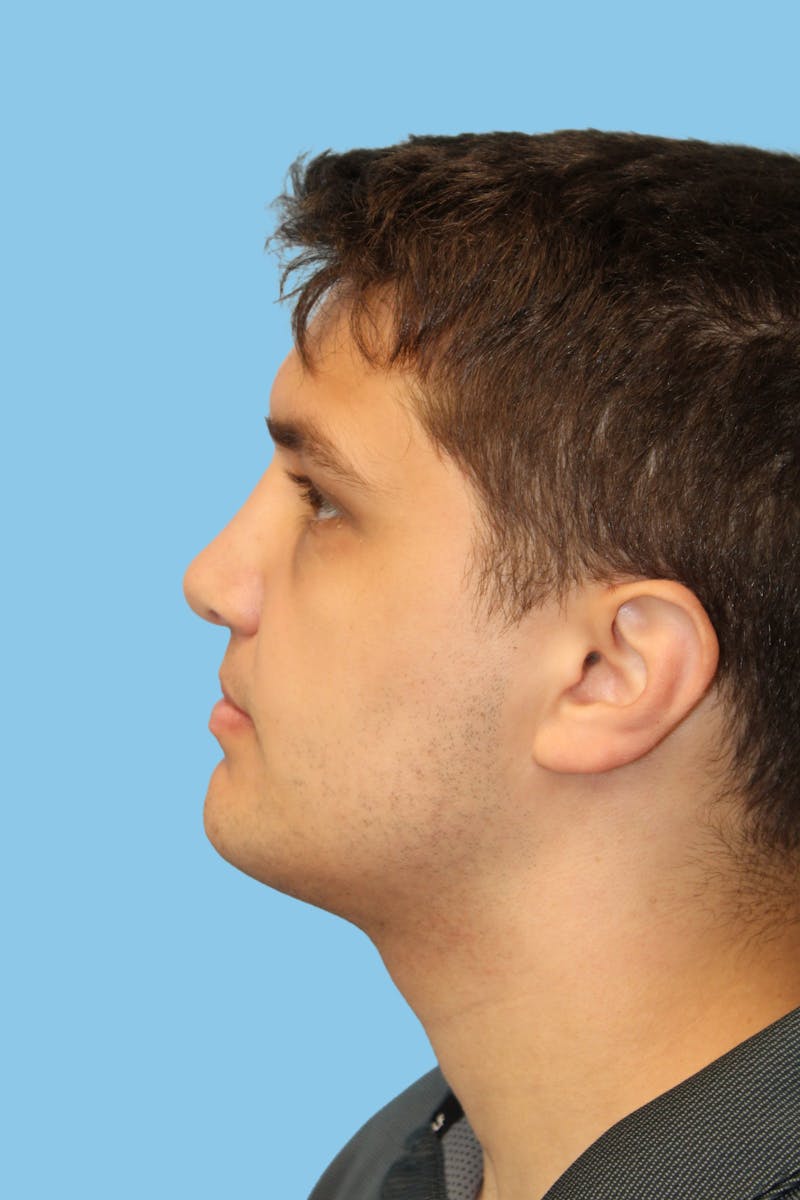 Rhinoplasty Before & After Gallery - Patient 396221 - Image 4