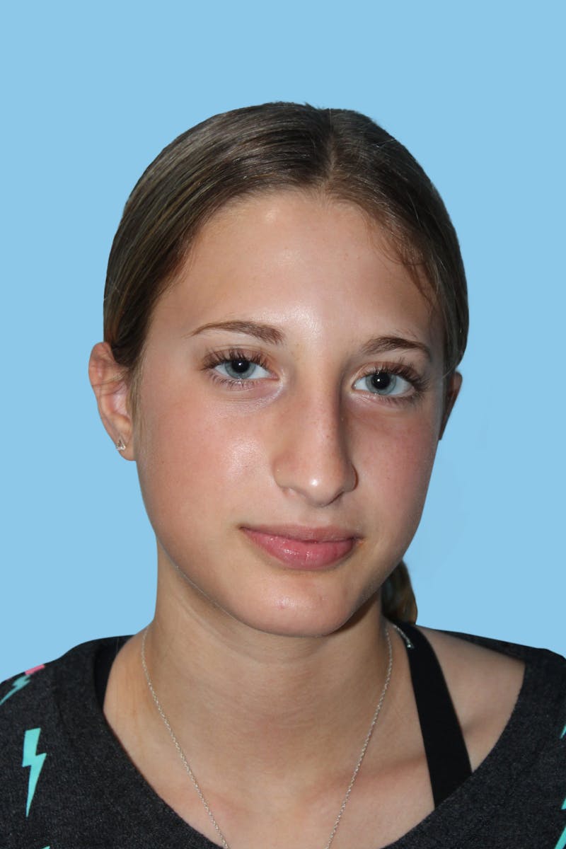Rhinoplasty Before & After Gallery - Patient 259881 - Image 1