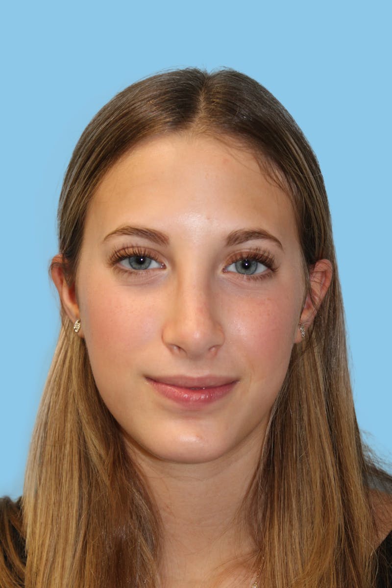Rhinoplasty Before & After Gallery - Patient 259881 - Image 2