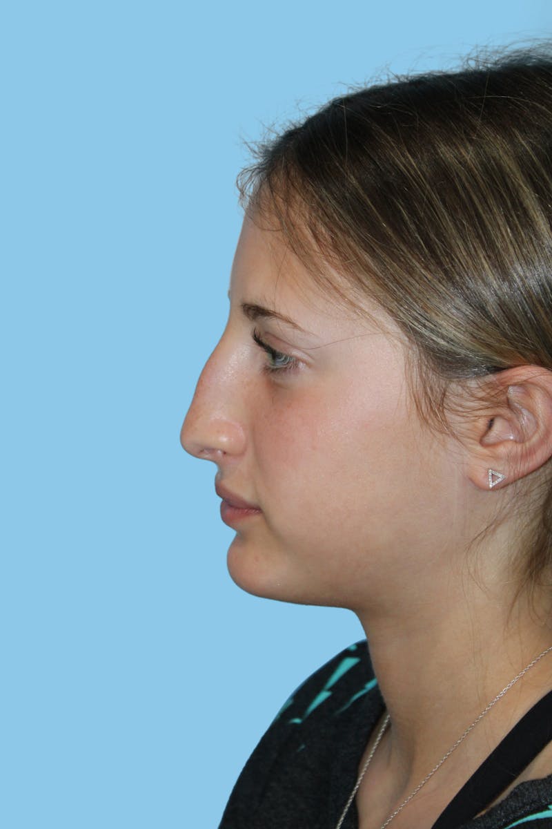 Rhinoplasty Before & After Gallery - Patient 259881 - Image 3