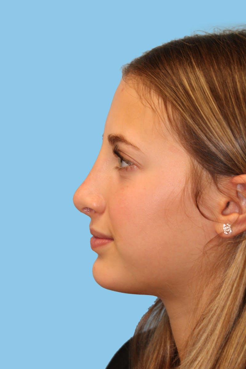 Rhinoplasty Before & After Gallery - Patient 259881 - Image 4