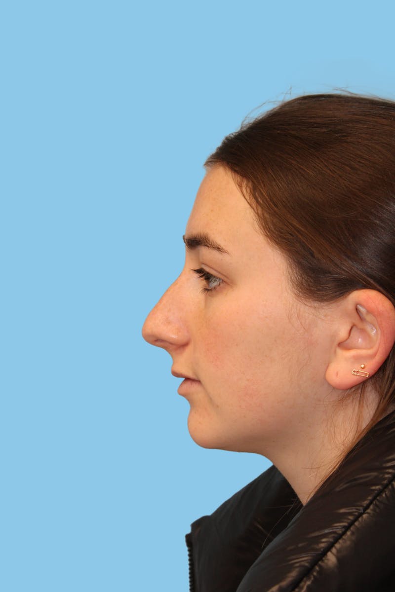 Rhinoplasty Before & After Gallery - Patient 391027 - Image 3