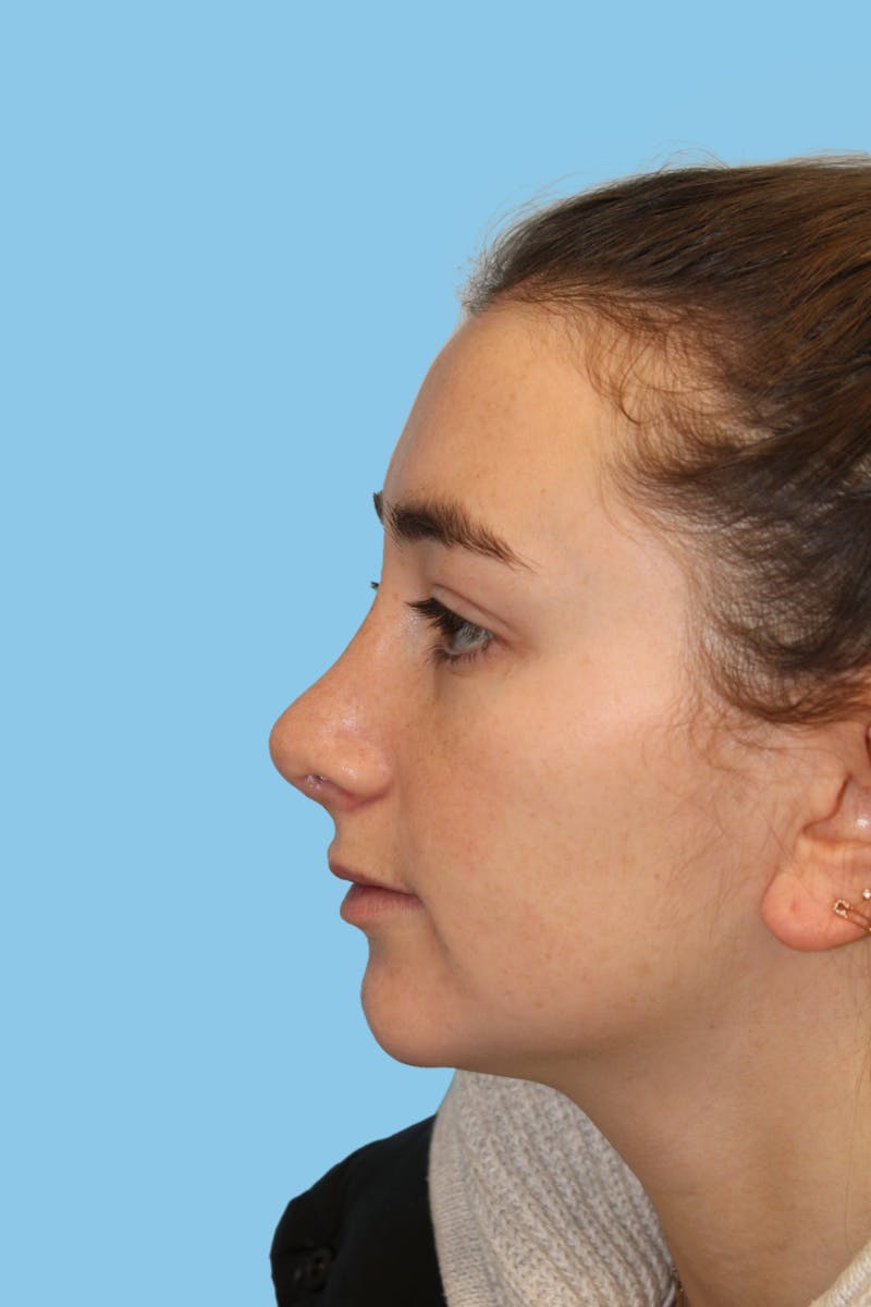 Rhinoplasty Before & After Gallery - Patient 391027 - Image 4