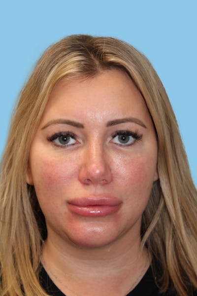 Rhinoplasty Before & After Gallery - Patient 142372 - Image 2