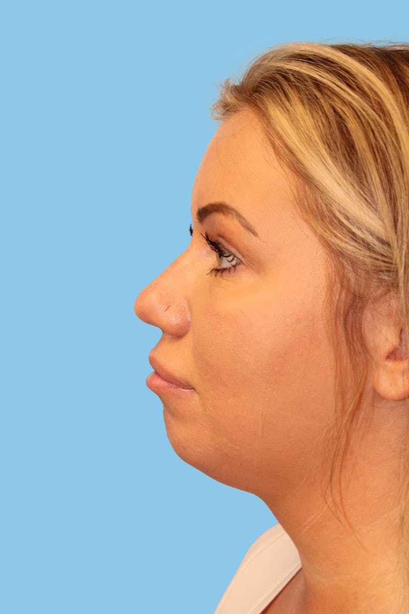 Rhinoplasty Before & After Gallery - Patient 142372 - Image 3