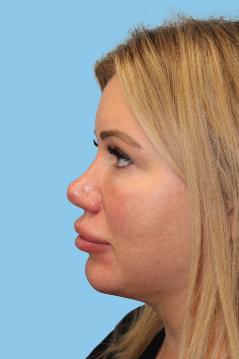 Rhinoplasty Before & After Gallery - Patient 142372 - Image 4