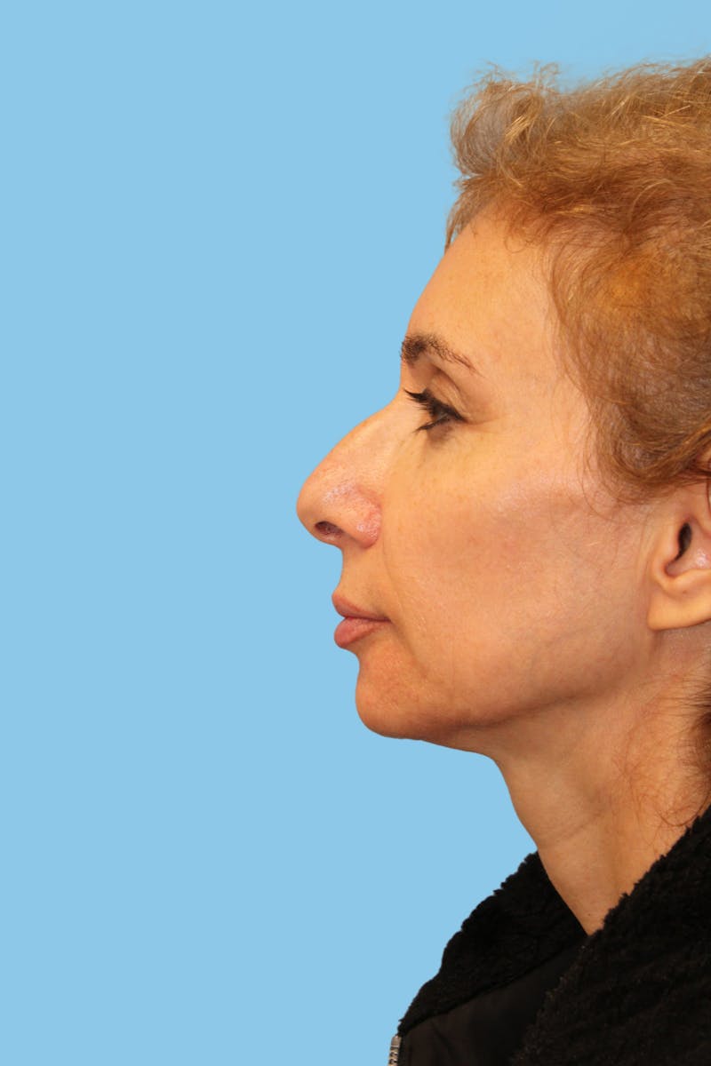 Rhinoplasty Before & After Gallery - Patient 250133 - Image 3