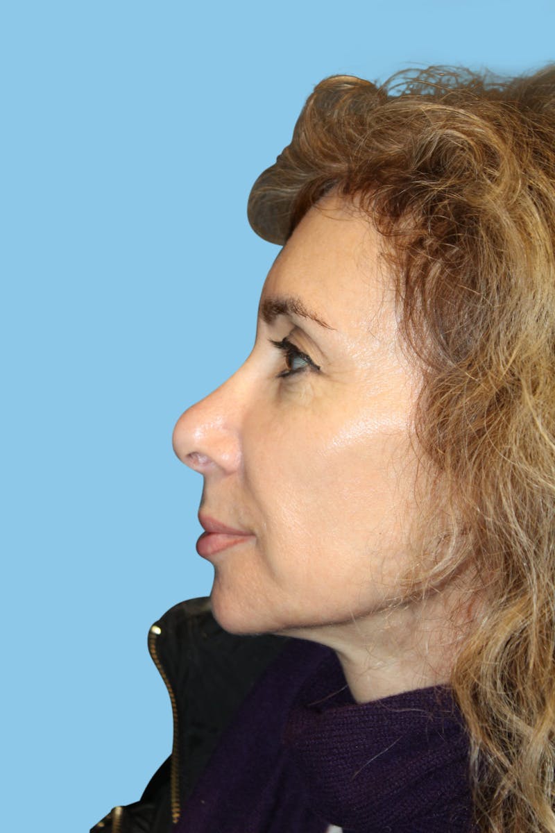 Rhinoplasty Before & After Gallery - Patient 250133 - Image 4