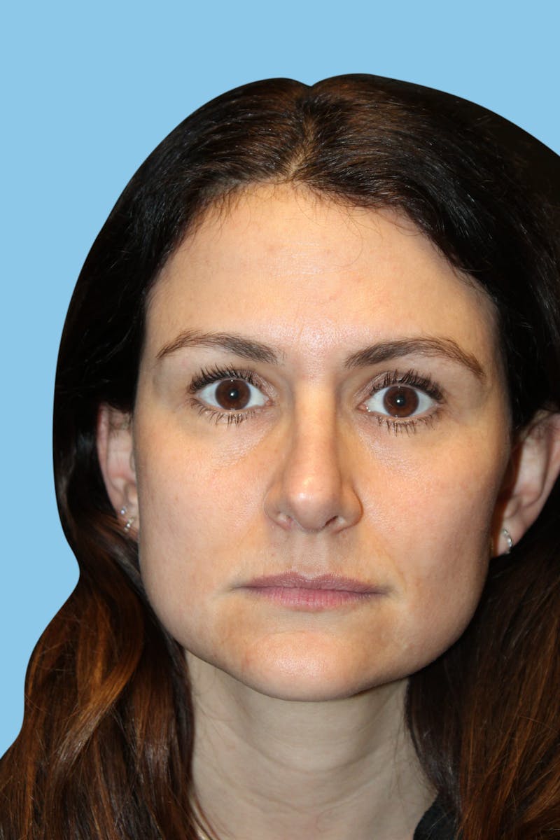 Rhinoplasty Before & After Gallery - Patient 184596 - Image 2