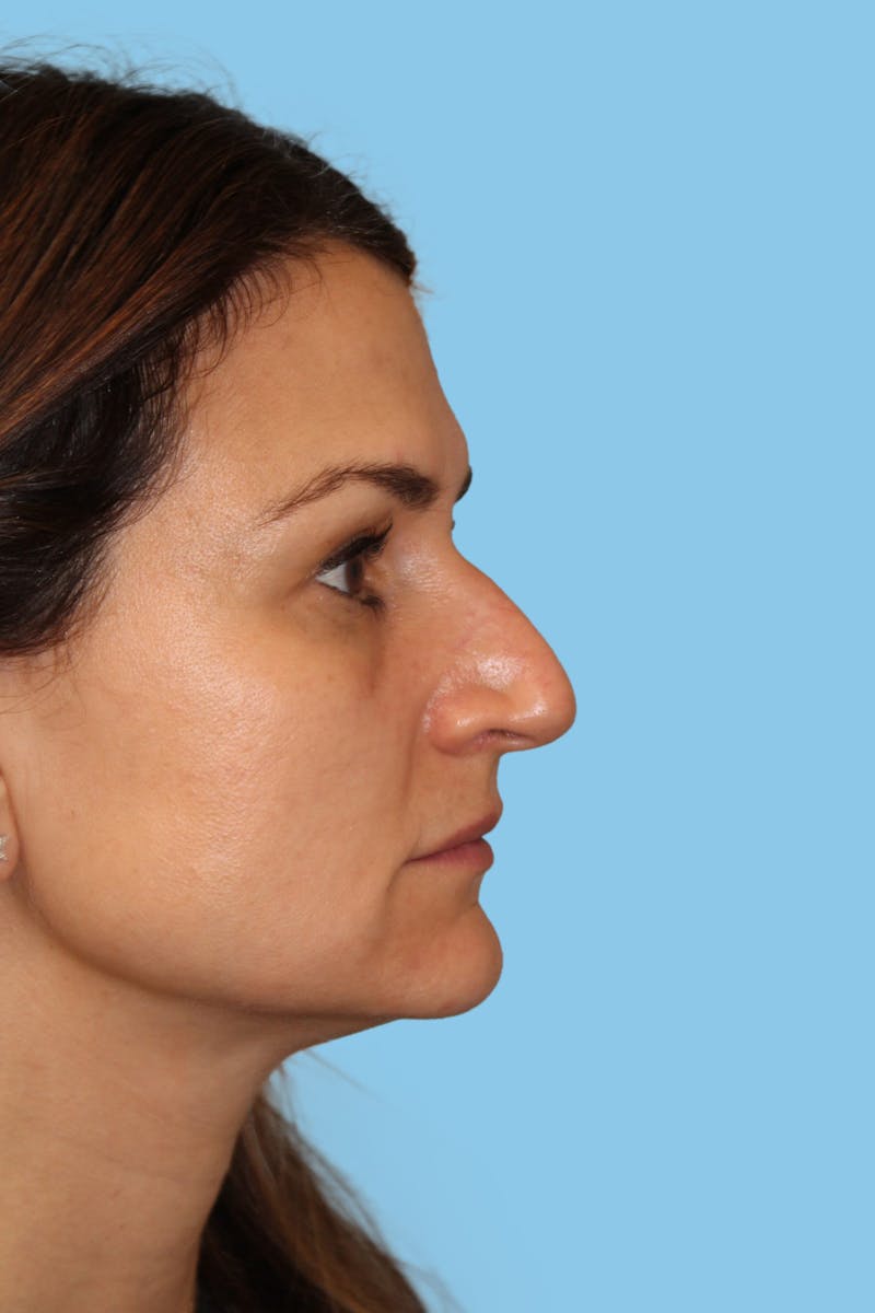 Rhinoplasty Before & After Gallery - Patient 184596 - Image 3