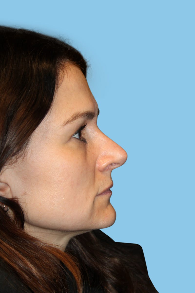 Rhinoplasty Before & After Gallery - Patient 184596 - Image 4