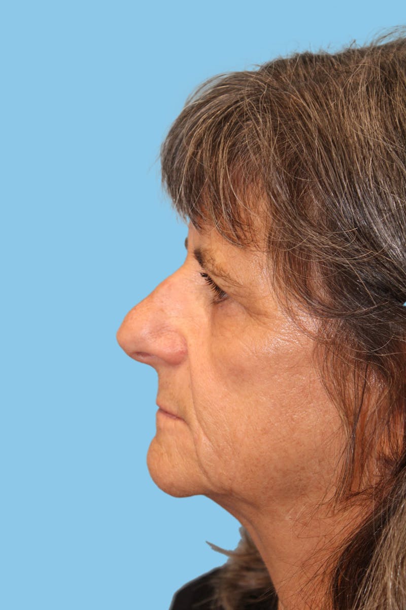 Rhinoplasty Before & After Gallery - Patient 348987 - Image 3