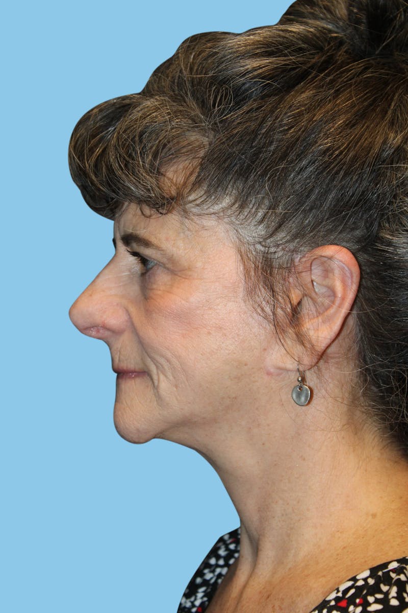 Rhinoplasty Before & After Gallery - Patient 348987 - Image 4