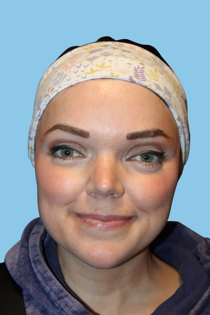 Rhinoplasty Before & After Gallery - Patient 822347 - Image 2