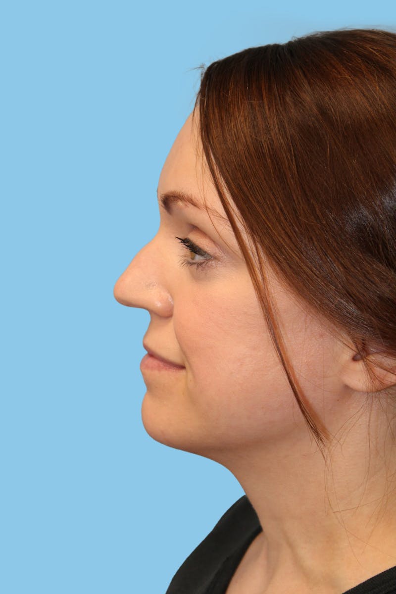 Rhinoplasty Before & After Gallery - Patient 822347 - Image 3