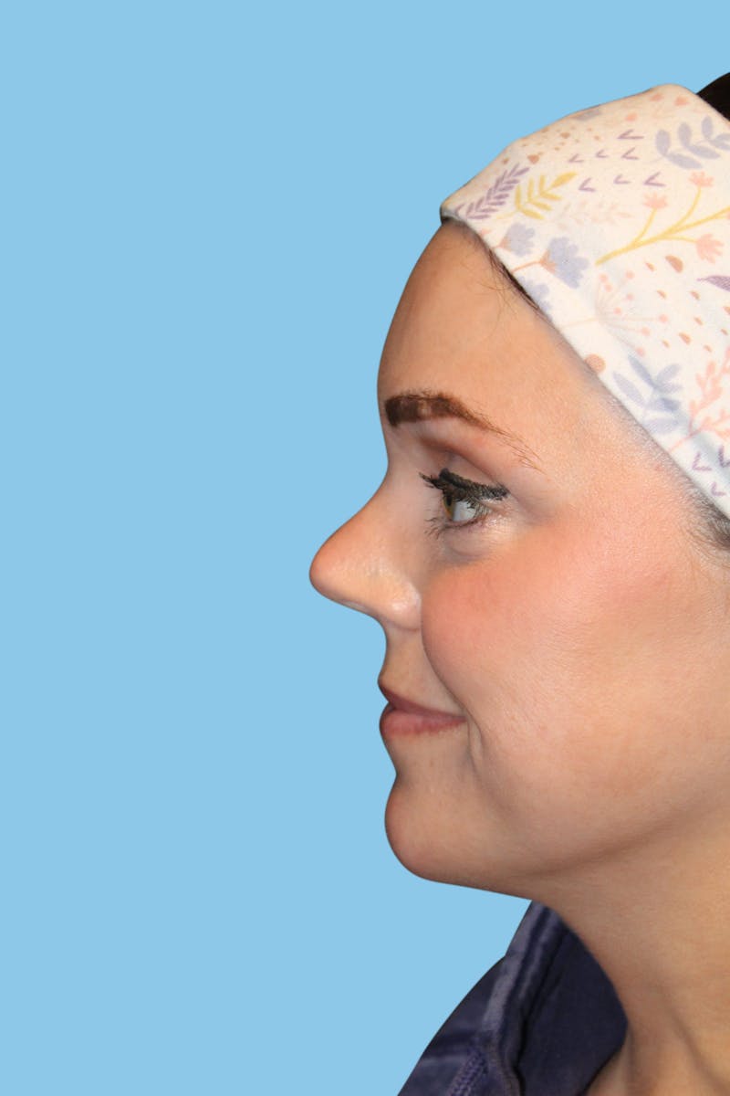 Rhinoplasty Before & After Gallery - Patient 822347 - Image 4