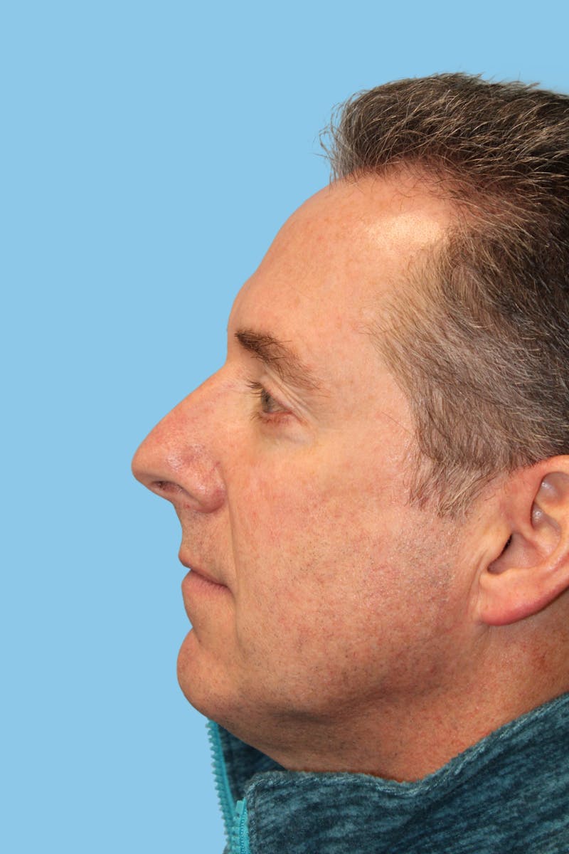 Rhinoplasty Before & After Gallery - Patient 391417 - Image 3