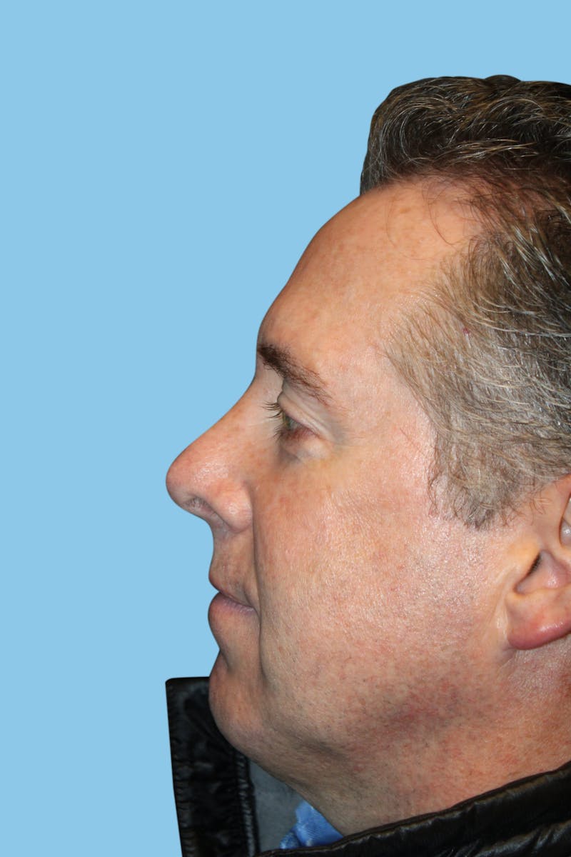 Rhinoplasty Before & After Gallery - Patient 391417 - Image 4