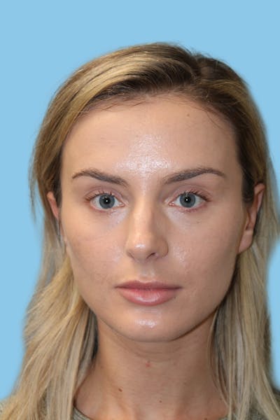 Rhinoplasty Before & After Gallery - Patient 166732 - Image 1