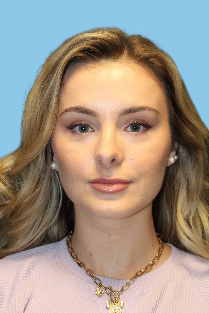 Rhinoplasty Before & After Gallery - Patient 166732 - Image 2