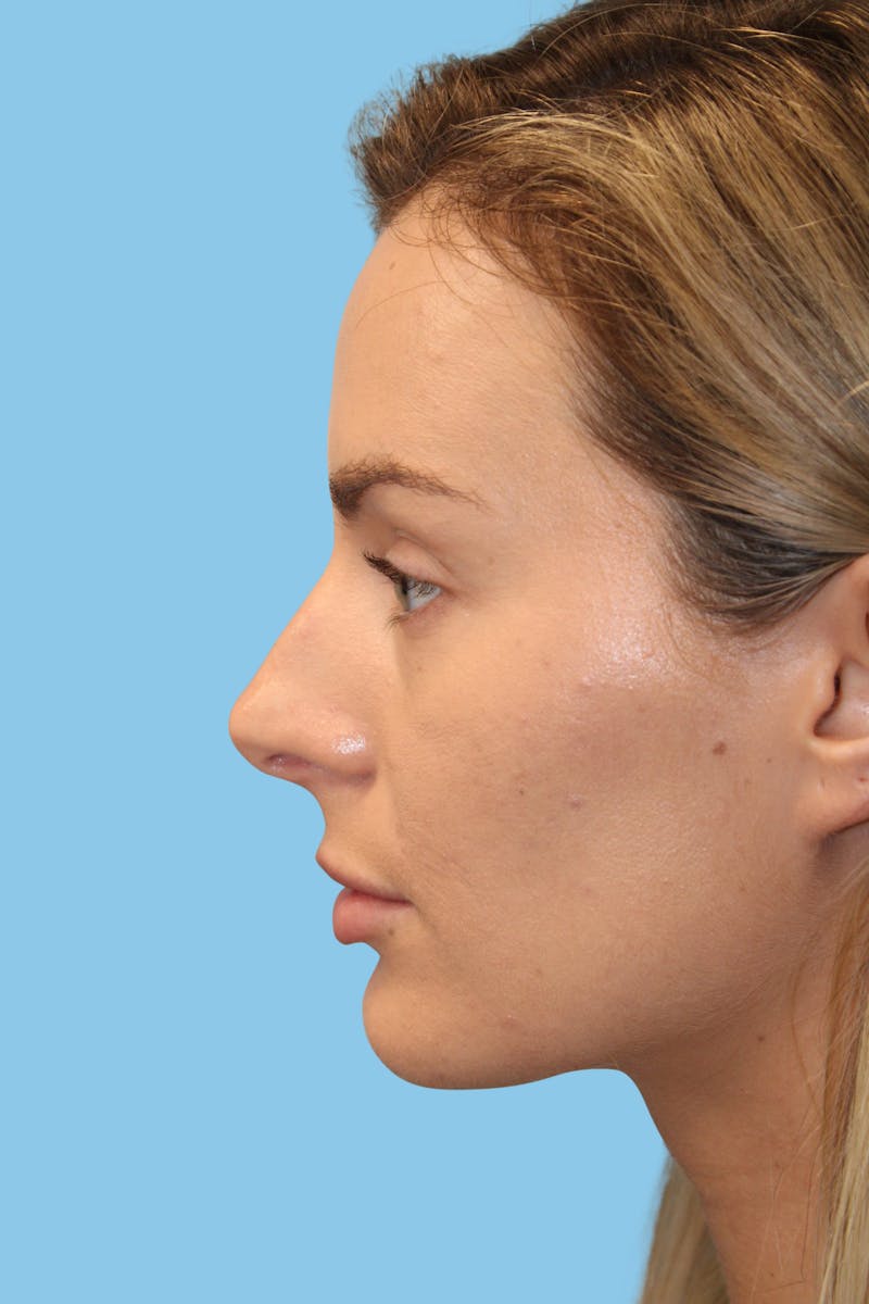 Rhinoplasty Before & After Gallery - Patient 166732 - Image 3